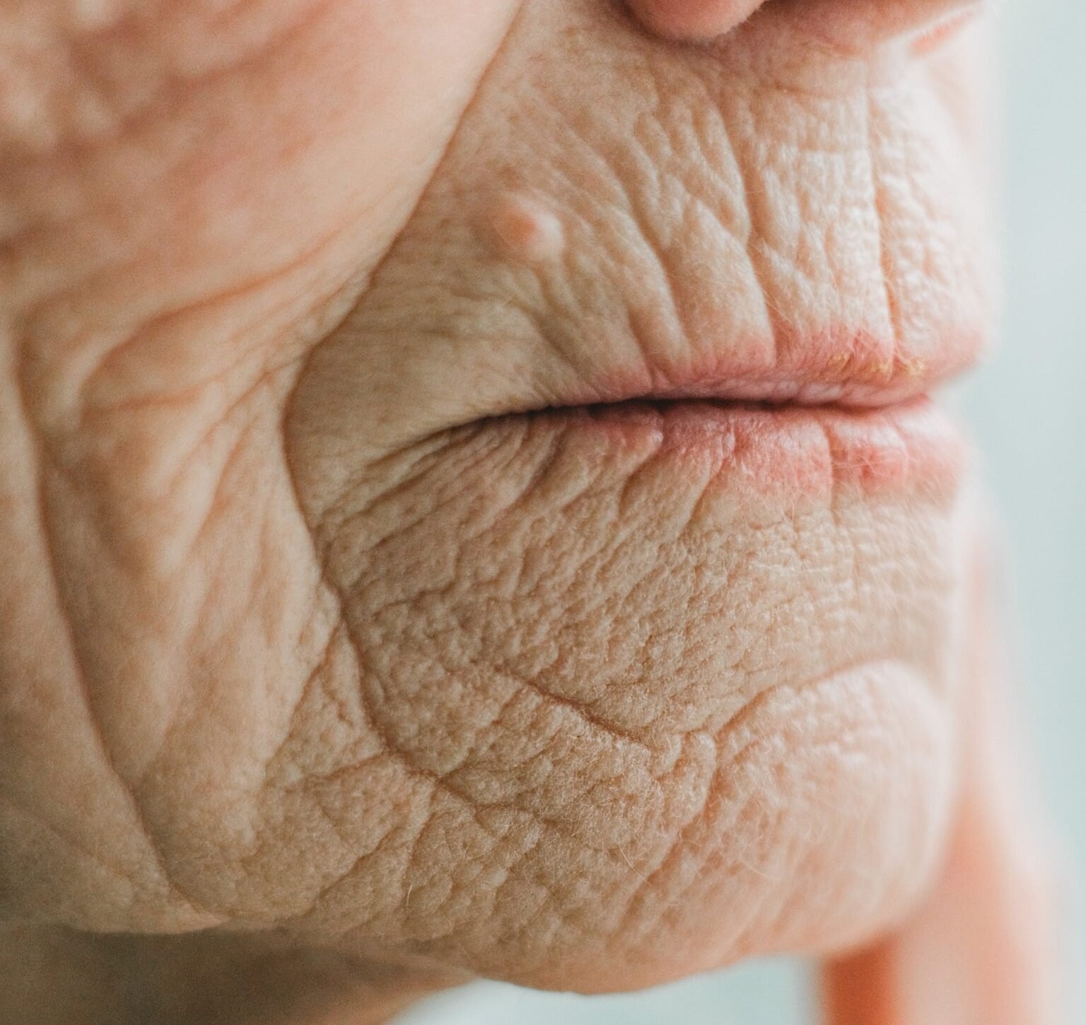 How to treat Wrinkles around the mouth