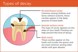 “10 Health Problems Caused by Rotten Teeth (And How to Prevent Them)”