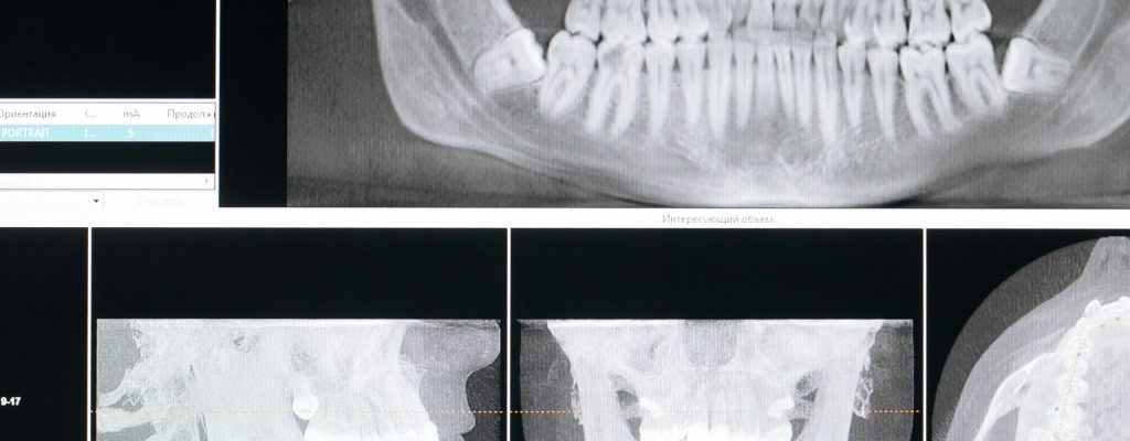 Detail image of a panoramic dental X-ray, showing teeth and jaw structure.