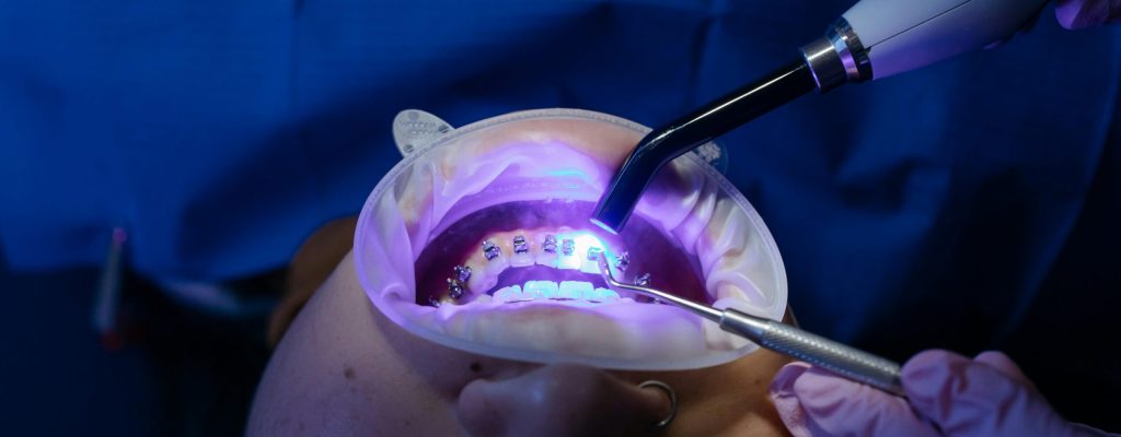 UV light curing dental procedure for teeth whitening and health care.